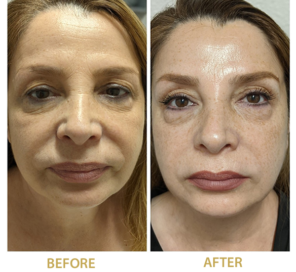 The TAMA Microcurrent treatment is a non-invasive, anti-aging, and revitalizing natural approach that utilizes a low-level electric pulse to tone the muscles in the face, and address a number of cosmetic concerns. The TAMA treatment benefits wrinkle reduction, eliminating fine lines, reduce acne and acne scars, skin pigmentation, skin laxity, and dullness, increase lymphatic drainage, releasing facia and relives muscle tension, by lifting and building firmness in the neck, cheeks, brows and jowls. 